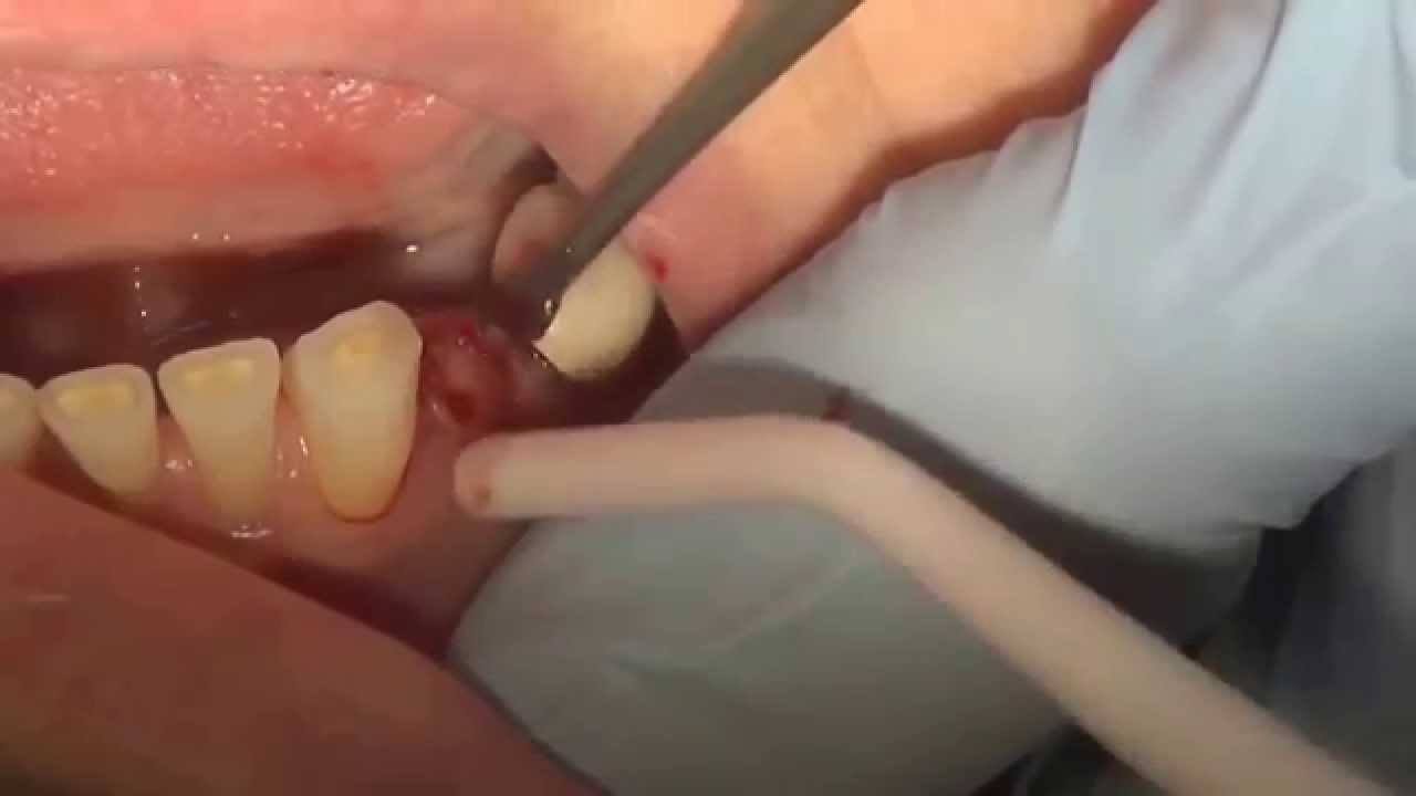 how do dentists remove broken teeth