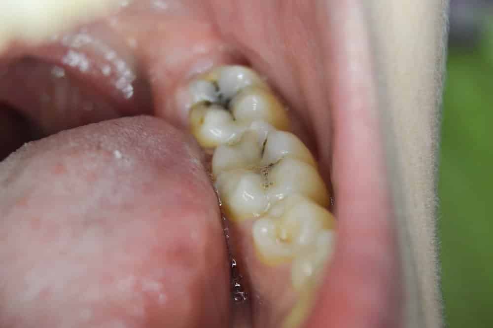 how to heal a cavity without fillings