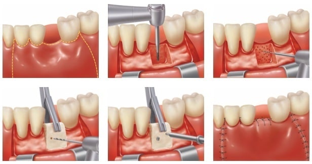 how to prevent further bone loss in teeth
