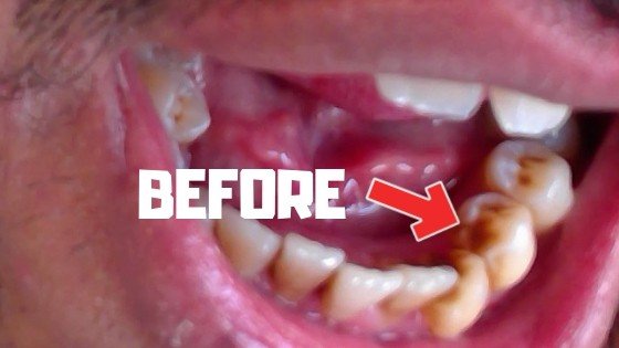 how to remove brown stains on teeth