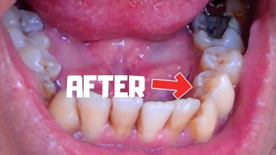 how to remove brown stains on teeth 