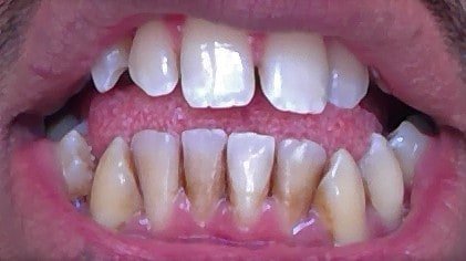 how to remove brown stains on teeth 