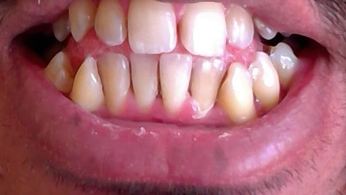how to remove brown stains on teeth 