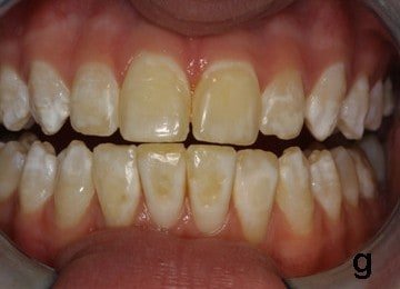 is fluoride bad for teeth