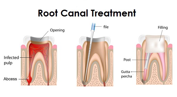 is getting a root canal painful