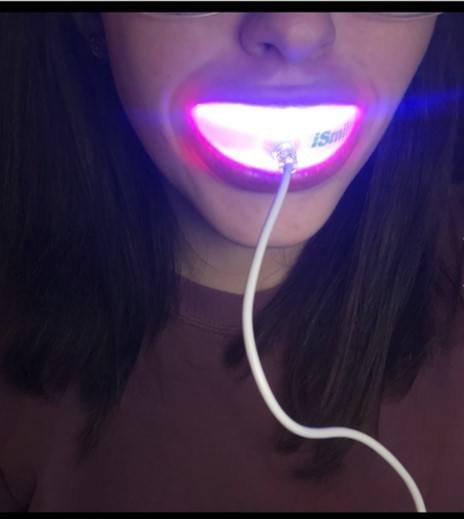 ismile teeth whitening kit