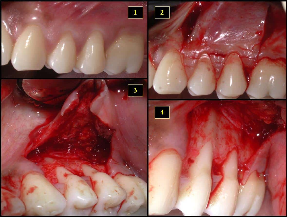 my gums are receding