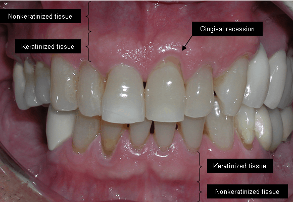 my gums are receding 