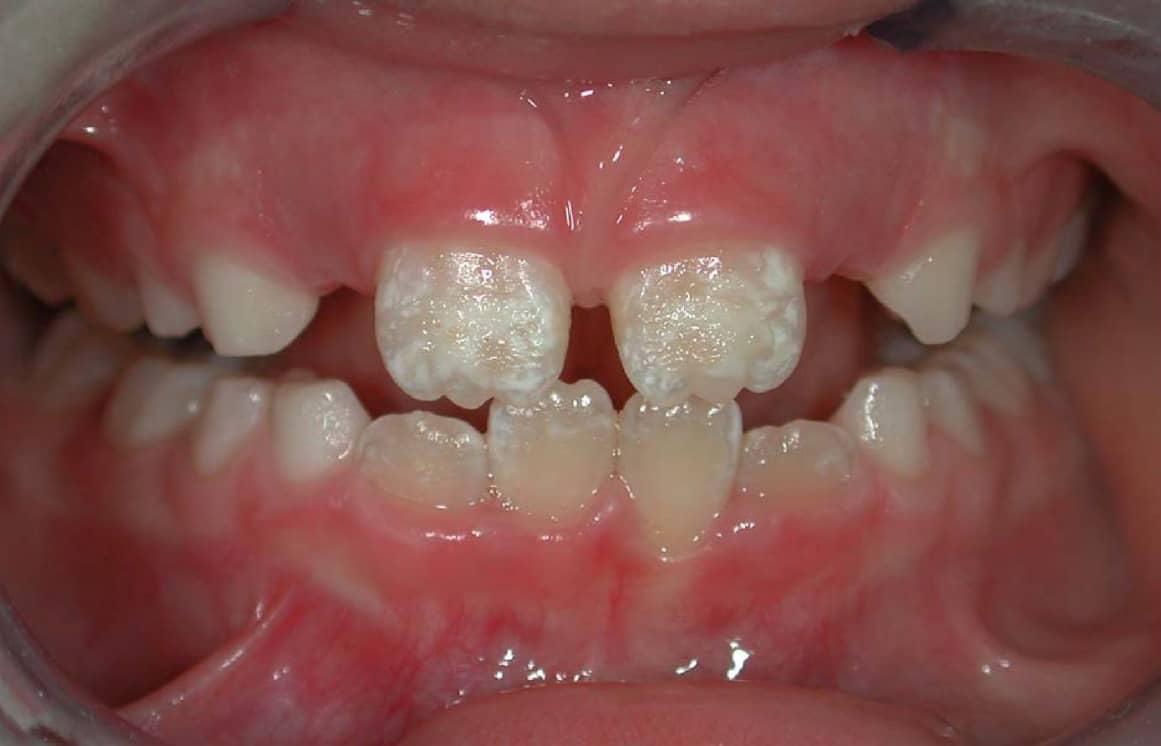 restoring tooth enamel naturally