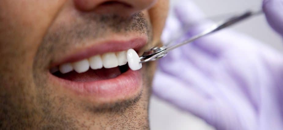 Porcelain veneers to remove white spots on teeth