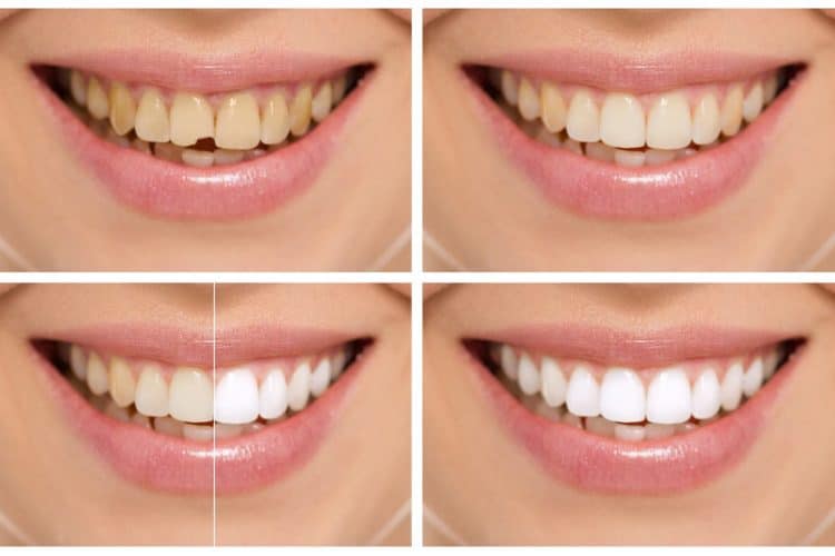 Bonding to remove white spots from teeth