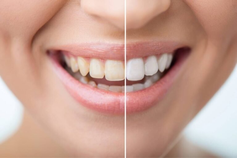 before-after-teeth-whitening